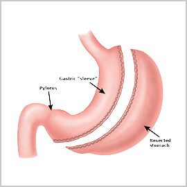 Gastric Sleeve