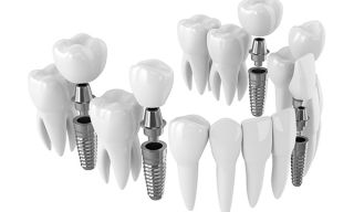 dental implants periodontist roseville Fusion Dental Implants