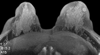 Breast MRI