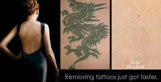 tattoo removal service santa ana Ink Off MD